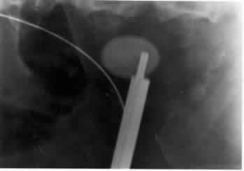 Lithrotripsy shock treatment or therapy.